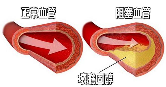 PG电子官方网站胆固醇偏高的人除了饮食之外平时还要注意这3大要素要重视(图3)